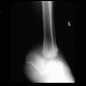 Charcot arthropathy, neuropathic arthropathy, Charcot joint: X-ray - Plain radiograph